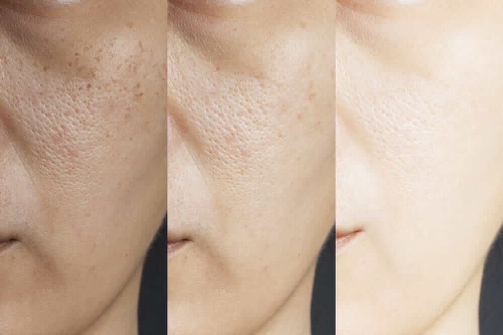 Nám da và điều trị nám