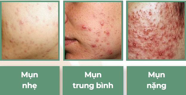 Vì sao bạn trị mãi mà không hết mụn? Bài viết sẽ giúp bạn chẩn đoán và điều trị mụn từ gốc.